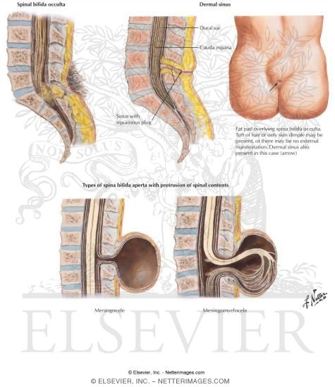 Defects of the Spinal Cord and Vertebral Column