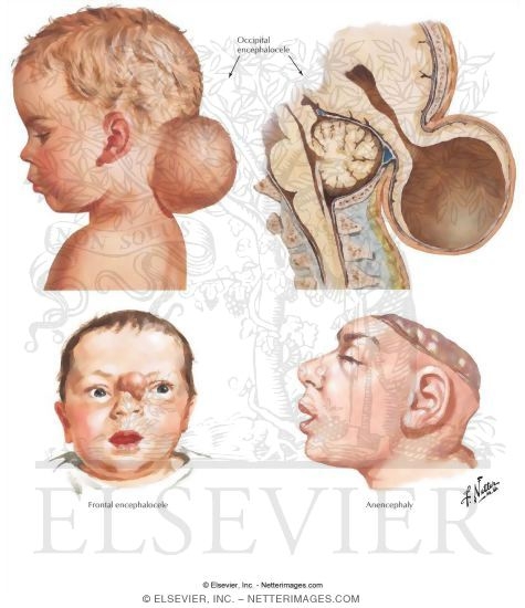 Defects of the Brain and Skull