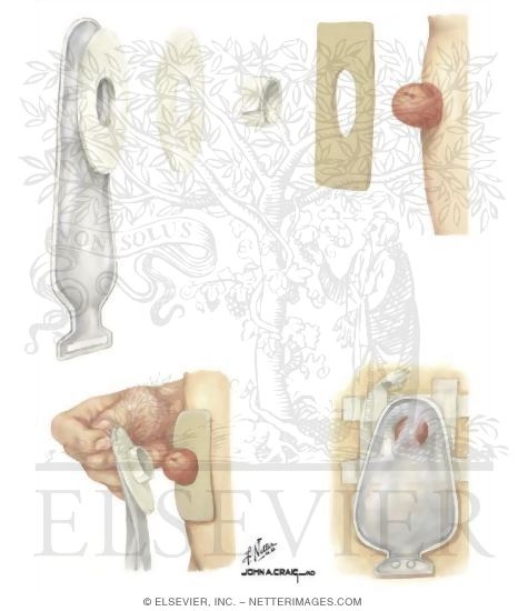 ileostomy vs colostomy