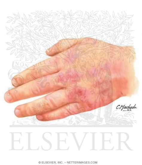Hand Dermatitis Dermatitis On Hands. Hand Dermatitis