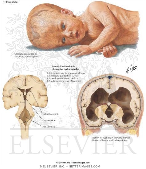 Hydrocephalus
