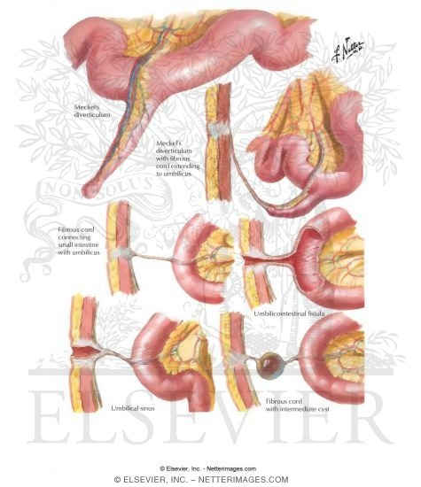 Meckel's Diverticulum - Vitelline Duct Remnants