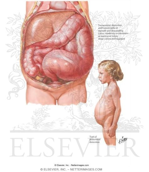 diseases of digestive system. (Hirschsprung#39;s Disease)