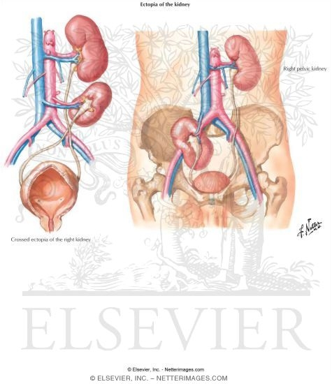 Ectopia of the Kidney