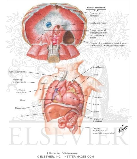 Congenital Diaphragmatic Hernia