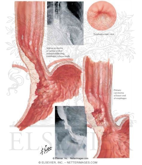 Malignant Tumors: Lower End of Esophagus