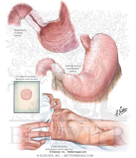 Hypertrophic Pyloric Stenosis