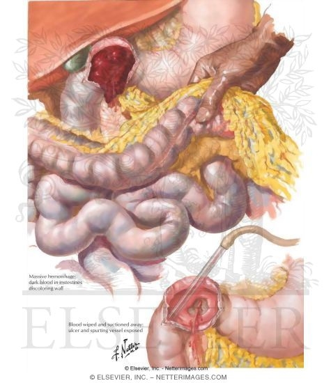 Peptic Ulcer VIII - Complications of Gastric and Duodenal Ulcers