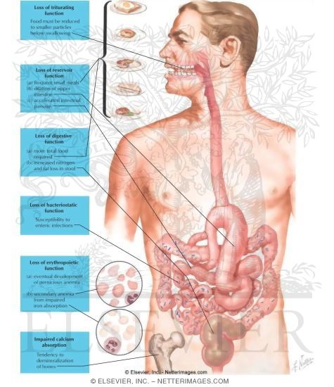 total gastrectomy