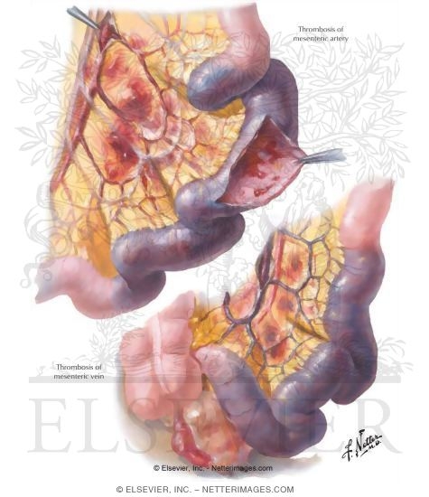 Mesenteric Vascular Occlusion