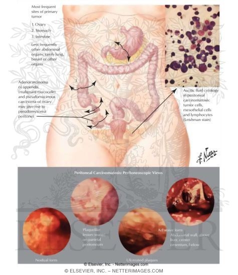Cancer of the Peritoneum