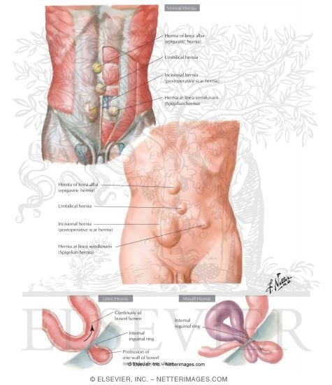 Abdominal Wall Hernia
