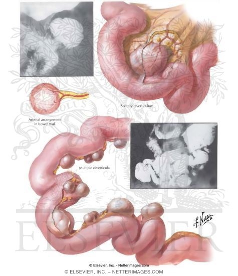 Diverticula of the Small Intestine