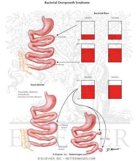 Bacterial Overgrowth Syndrome