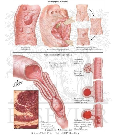 Peutz-Jeghers syndrome - Genetics Home Reference