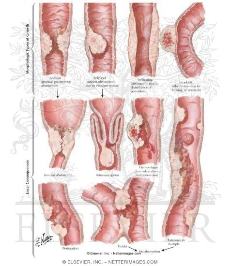 Malignant Tumors