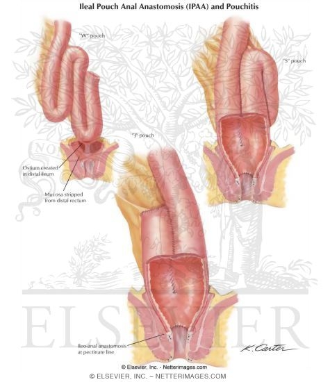 Ileal Pouch Anal Anastomosis (IPAA) and Pouchitis