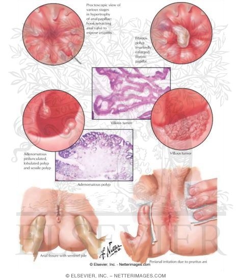 Proctologic Conditions III - Papillitis, Cryptitis, Adenomatous Polyps, Villous Tumor, Fissure and Pruritus Ani