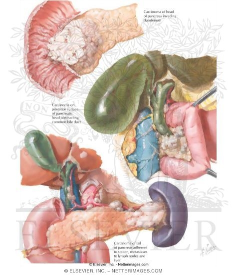 Pancreatic Cancer: Clinical Features