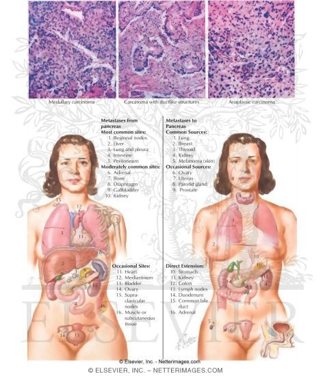 Pancreatic Cancer: Advanced Disease, Including Histology and Mestastases