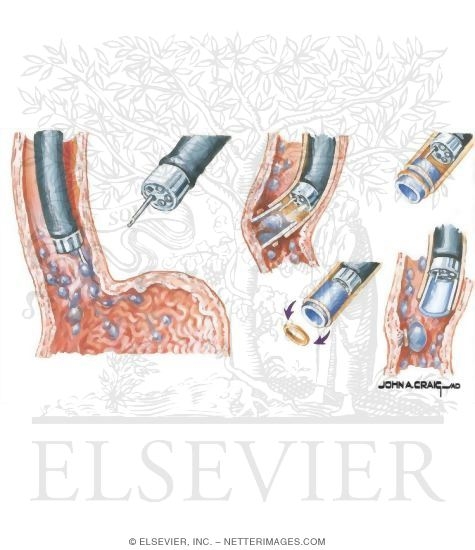 Variceal Bleeding: Ligation Techniques