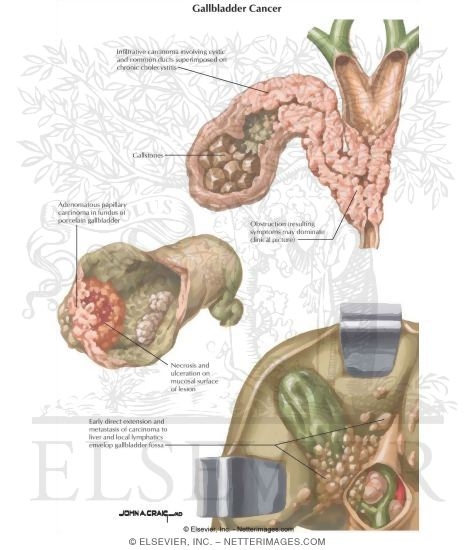 gallbladder anatomy pictures. Gallbladder Cancer