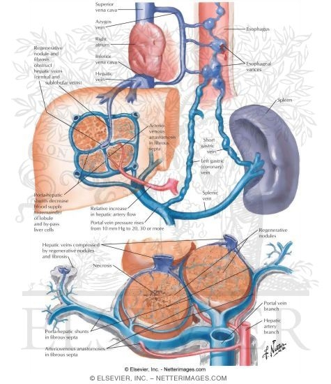 Cirrhosis II - Fundamental Vascular Changes