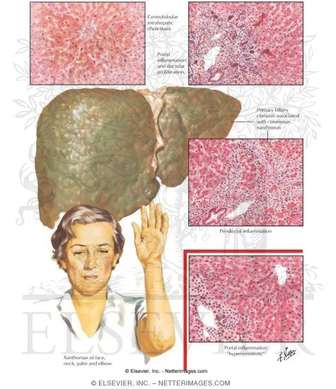 Cholestatic Liver Disease