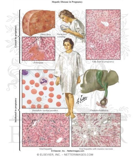 Hepatic Disease In Pregnancy