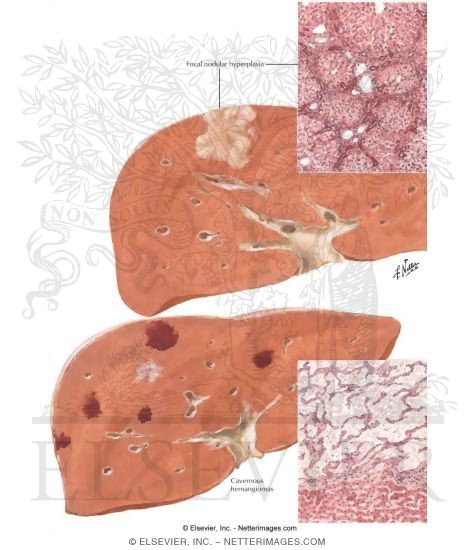 Tumors I - Hamartomas, Hemangiomas