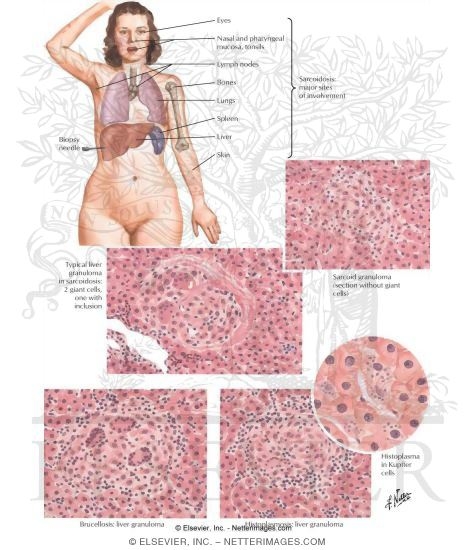 Sarcoidosis, Brucellosis, Histoplasmosis