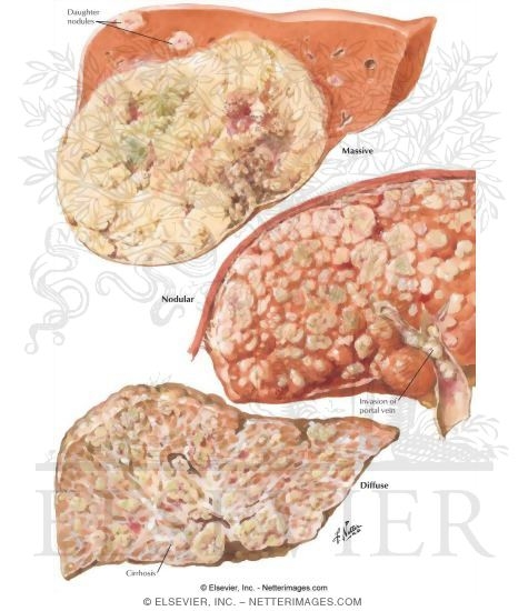 Tumors II - Primary Hepatic Carcinoma