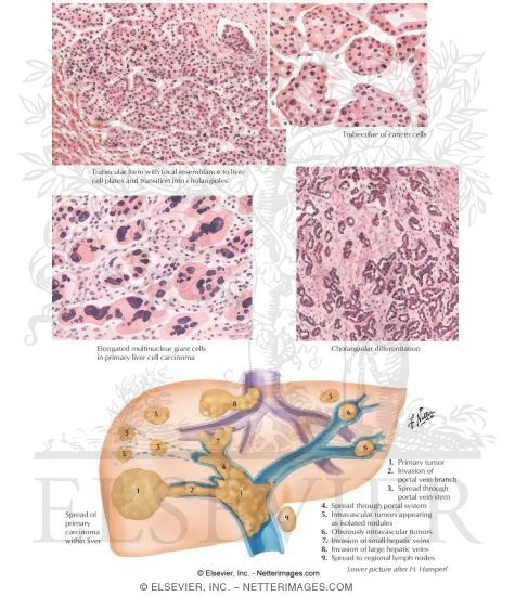 Tumors III - Histology and Spread of Primary Carcinoma