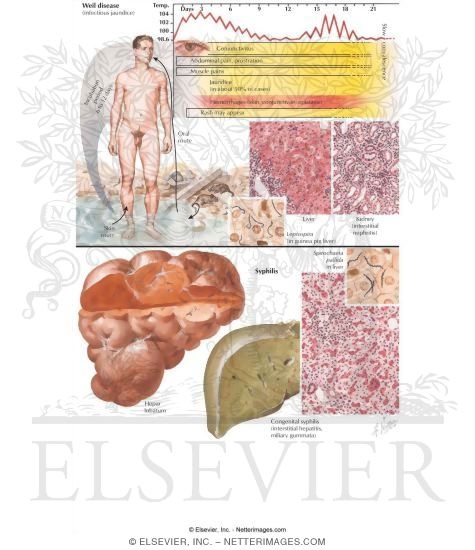 Spirochetal Infections: Weil Syndrome and Syphilis