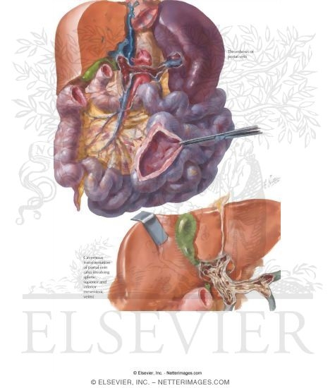 Portal Venous Obstruction