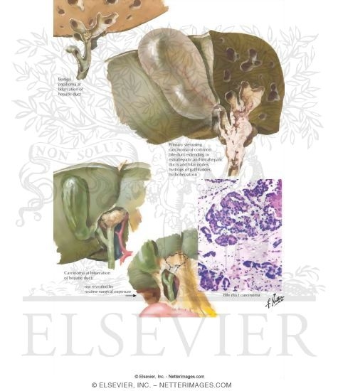 Bile Duct Cancer: Benign Papilloma and Carcinomas