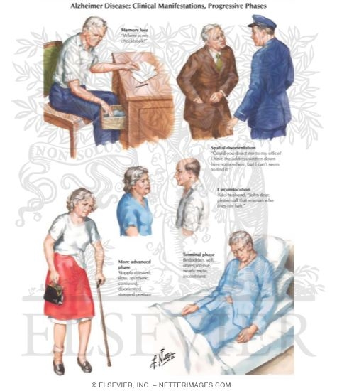 Alzheimer Disease: Clinical Manifestations, Progressive Phases