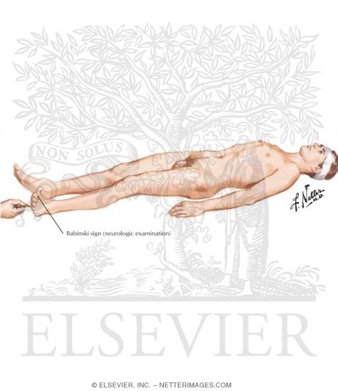 Elicitation of the Babinski Sign