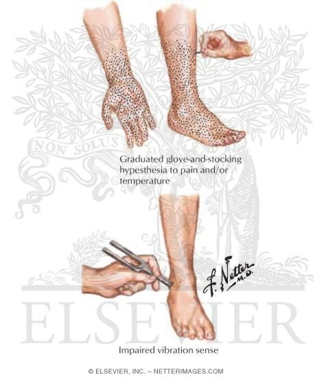 Documentation of Various Types of Sensory Modalities In a Peripheral Neuropathy