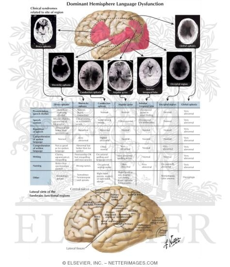 Dominant Hemisphere Language Dysfunction