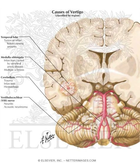 Causes of Vertigo