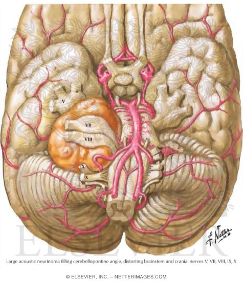 Acoustic Neurinomas