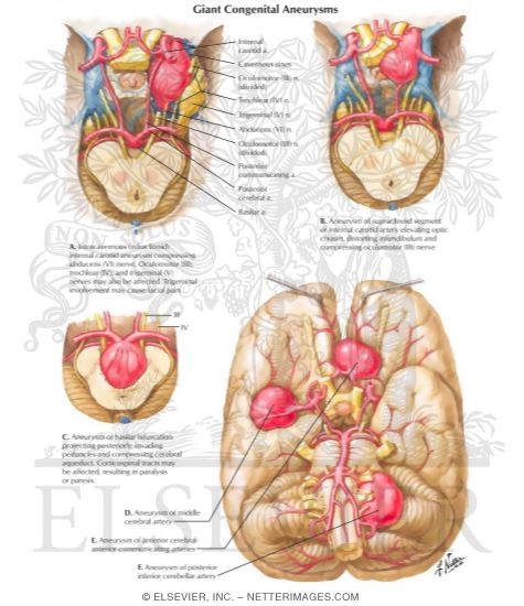 Giant Congenital Aneurysms