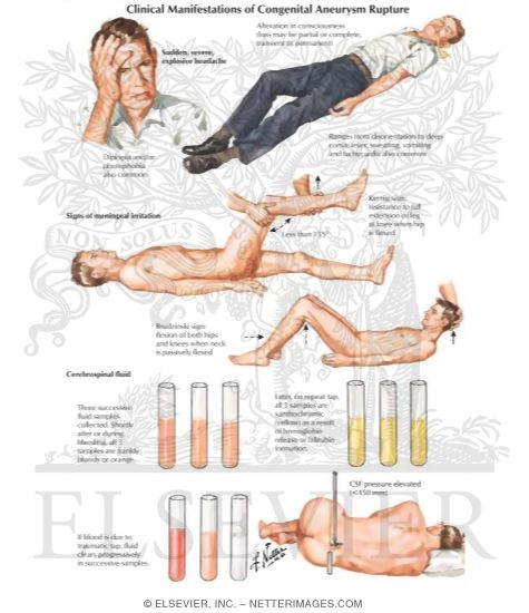 Motor neuron disease examination