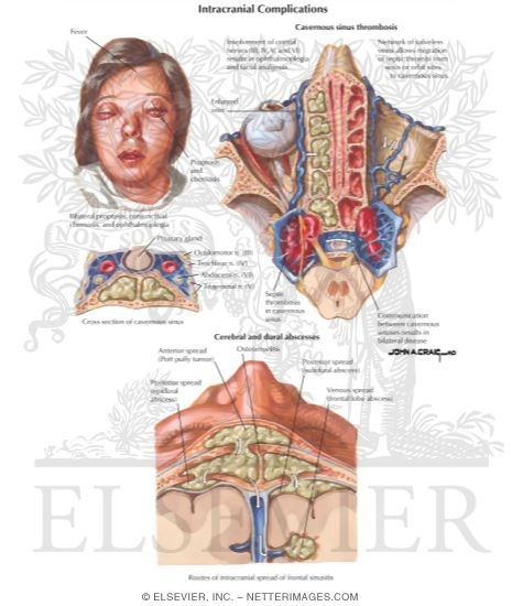 Intracranial Complications
