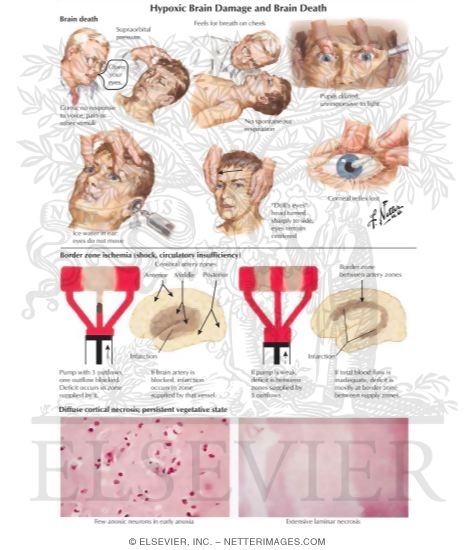 Brain Death