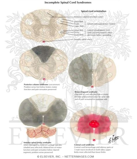 Cervical Spine Injury: Incomplete Spinal Cord Syndromes