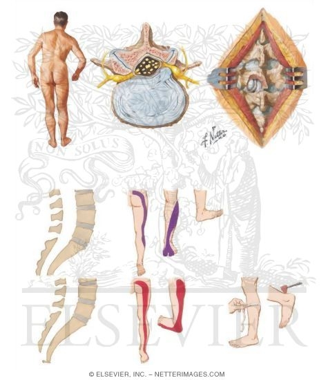 Herniation of a Lumbar Disc