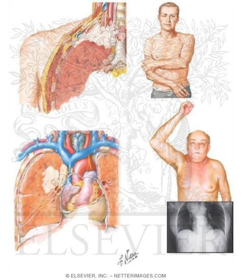 Pancoast and Superior Vena
