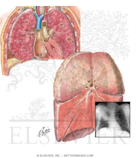 Pneumonia
